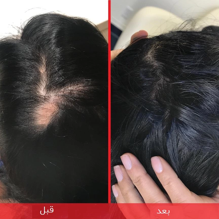 قرص هیرتامین,کپسول هیرتامینhairtamin,مکمل هیرتامین,هیرتامین اصل